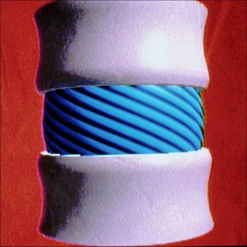 twisting effect on disc